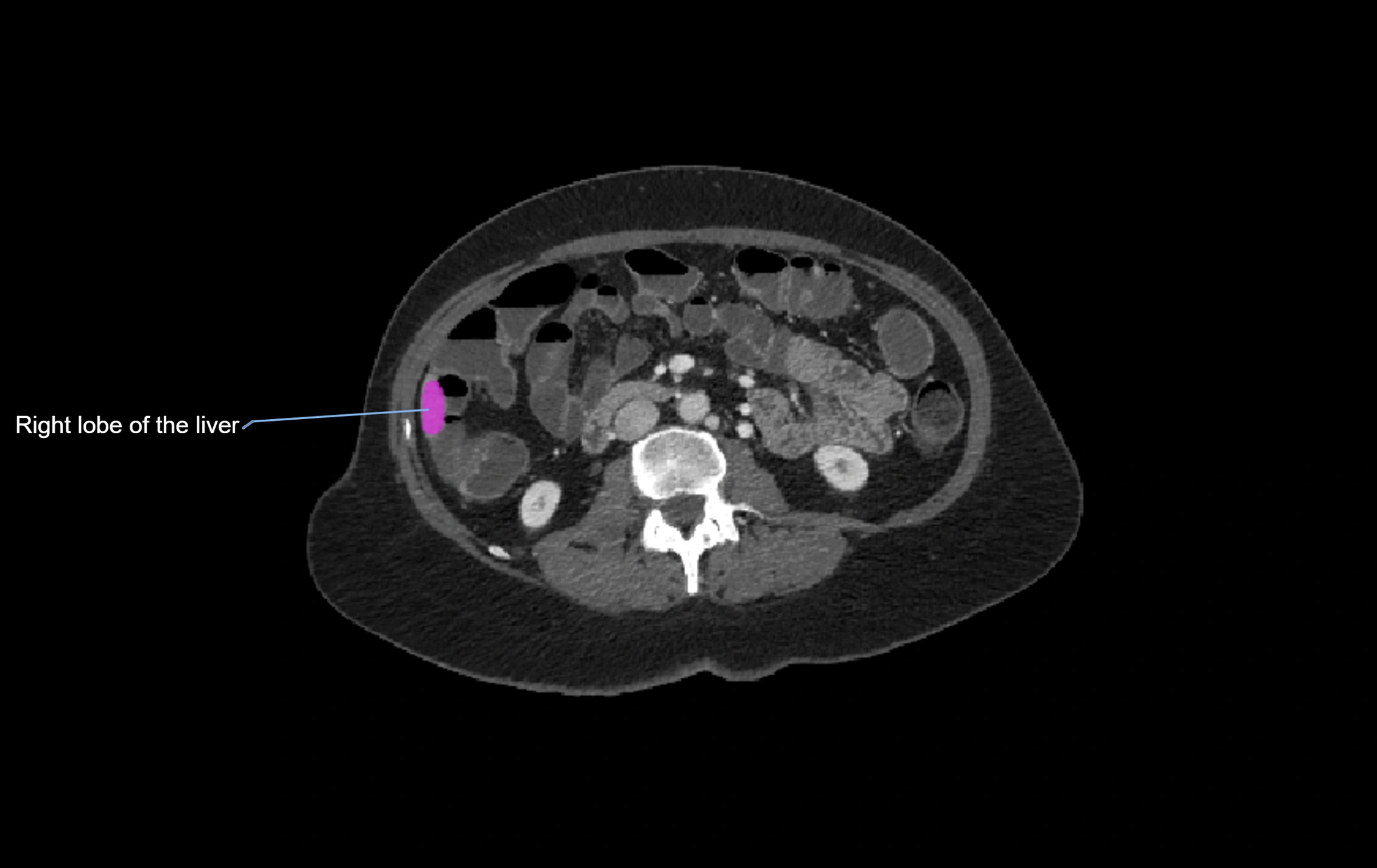CT lliver lobes axial cross sectional anatomy labelled image -00003.webp